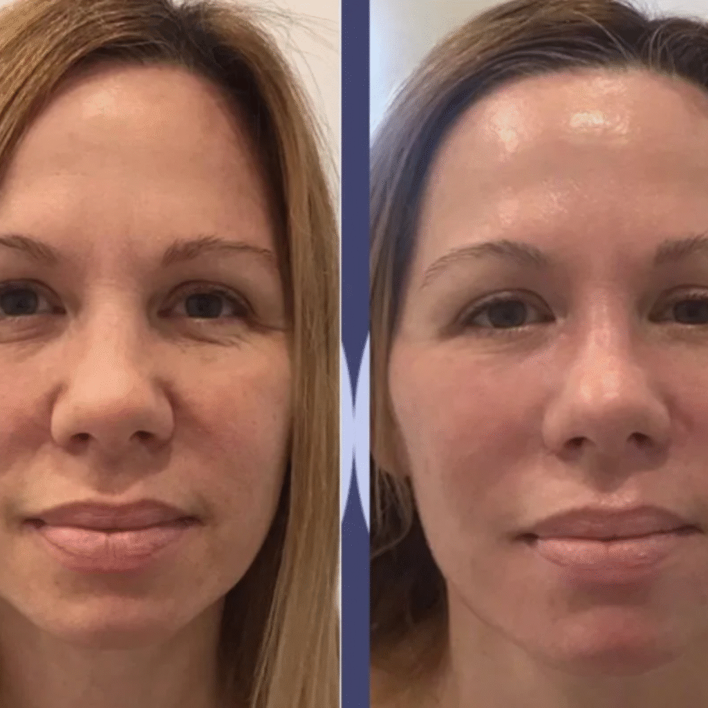 Before and after facial results at Pelle Sana Facial Spa in Hummelstown PA showing clear, radiant skin.