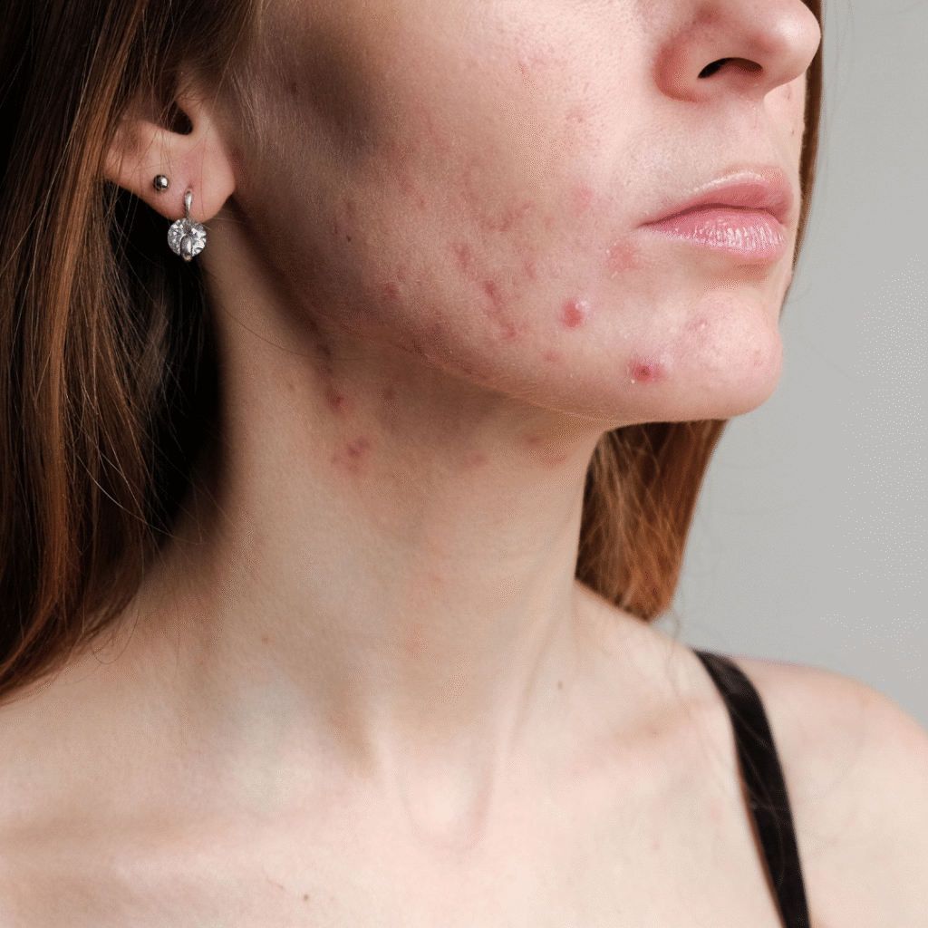 Acne Treatment and Facial at Pelle Sana Facial Spa in Hummelstown PA